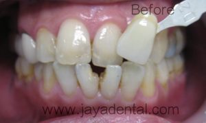 Emax crowns 11,21, 31,41 pre-tx