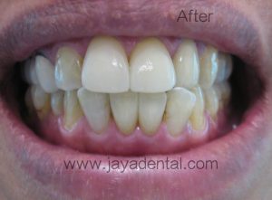 Emax crowns 11,21,31,41 post-tx