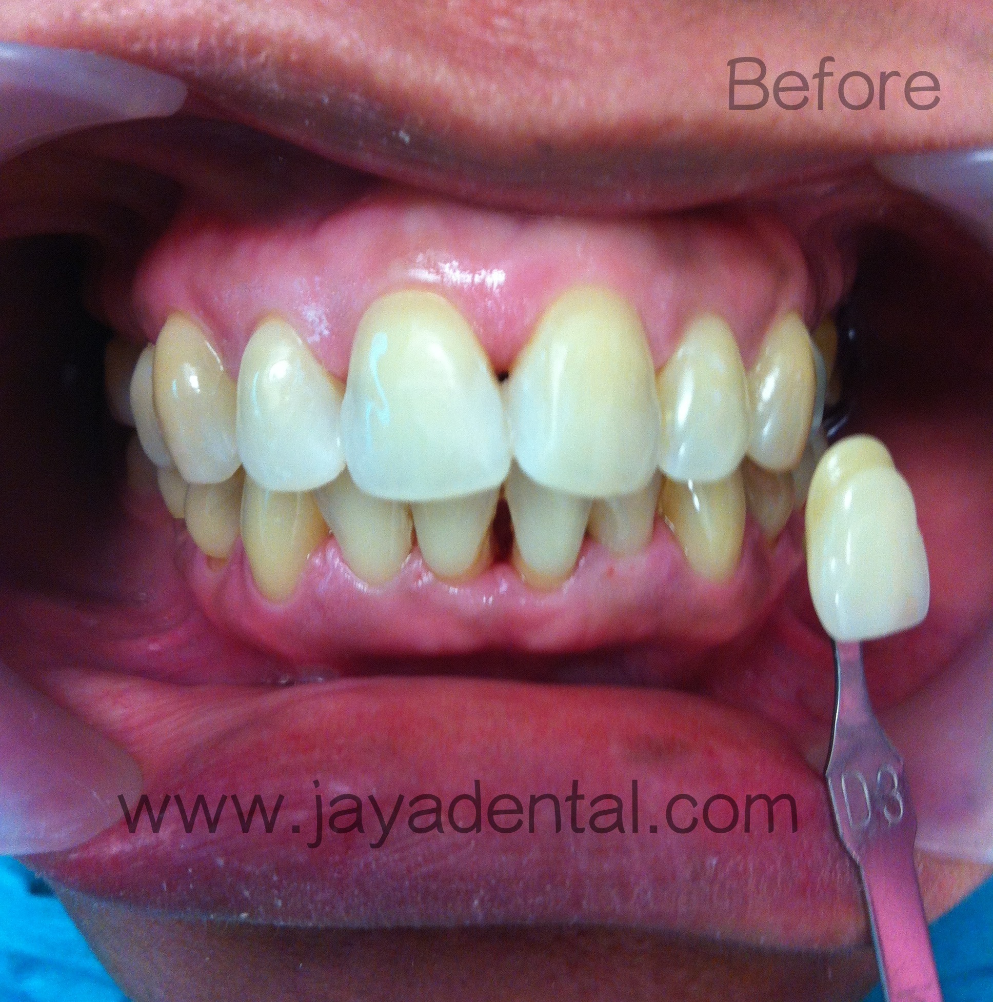 Case 1(before tx_shade D3) Jaya Dental Surgery
