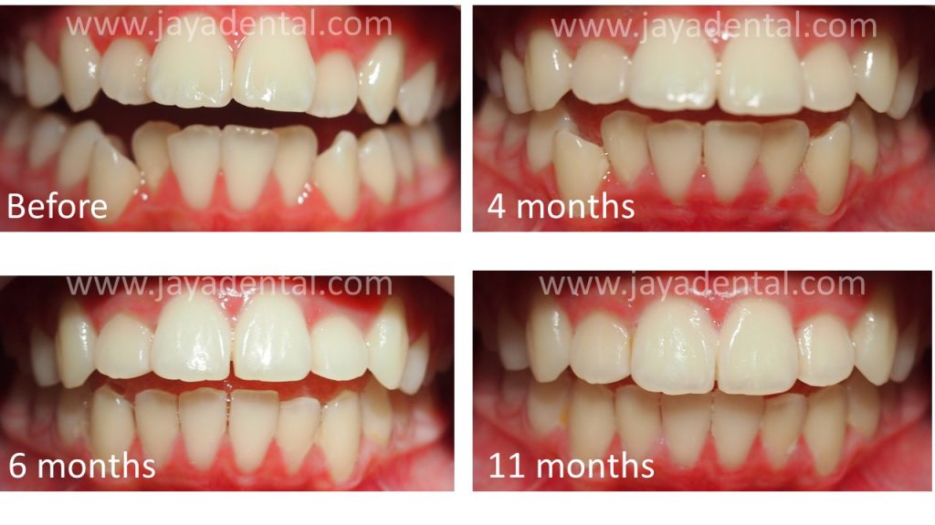clear-aligner-jaya-dental-sugery-1