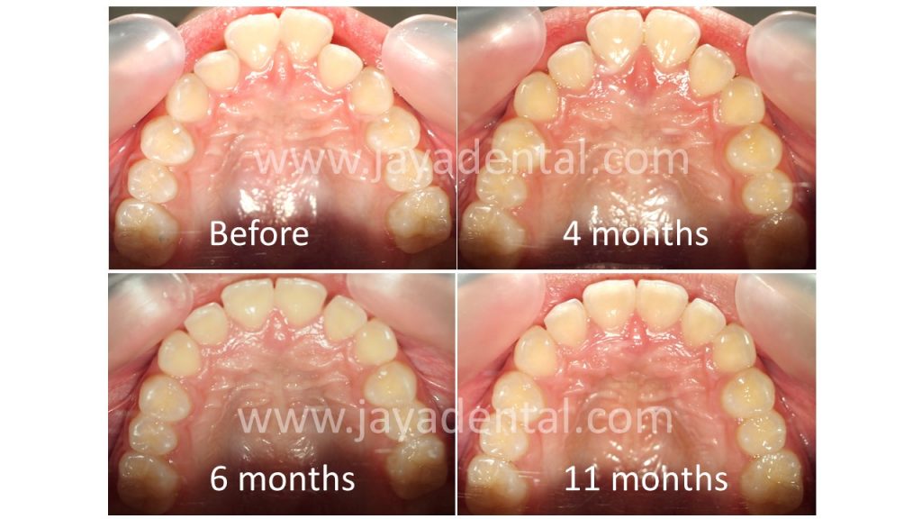 clear-aligner-jaya-dental-sugery-2