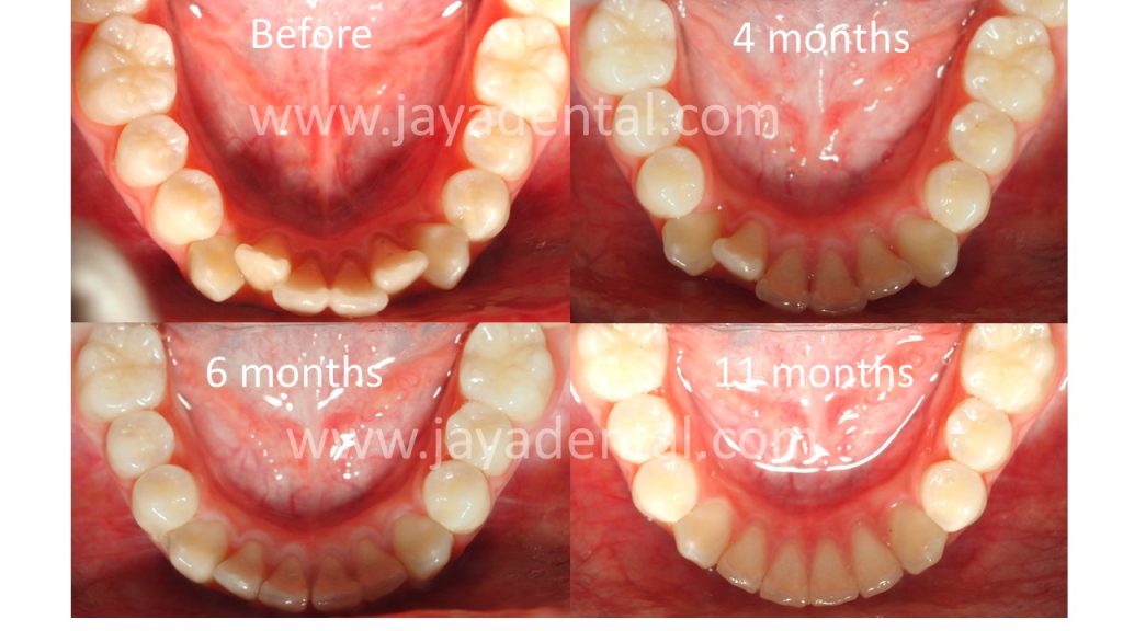 clear-aligner-jaya-dental-sugery-3