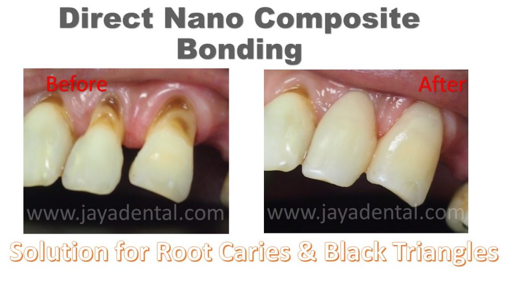 direct-nano-composite-jaya-dental-surgery