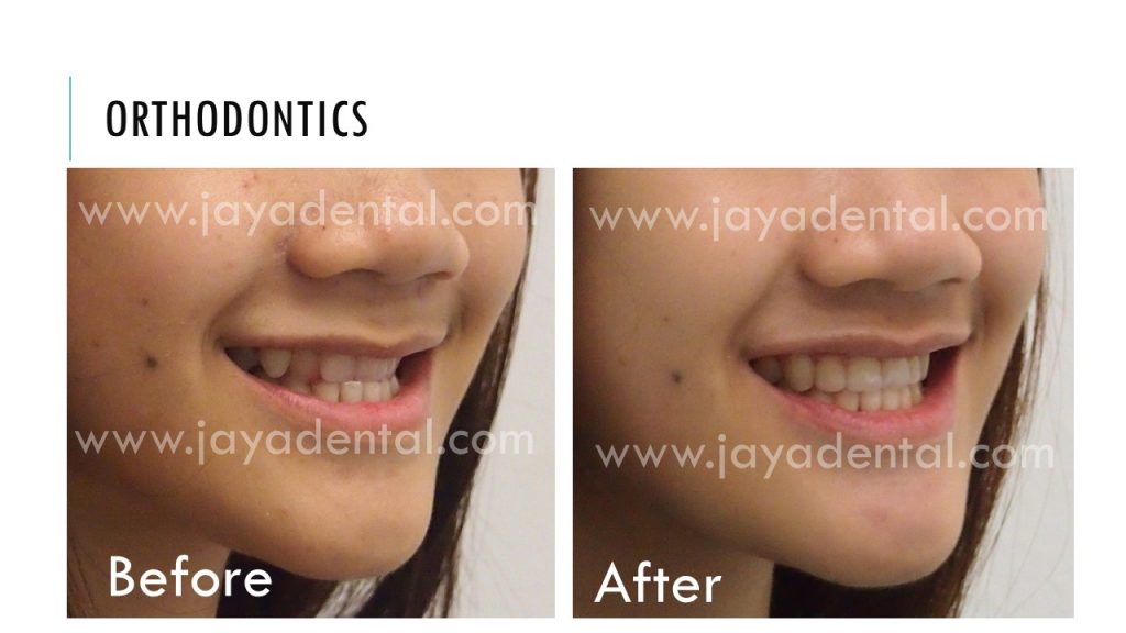before-after-fixed-braces-jaya-dental2