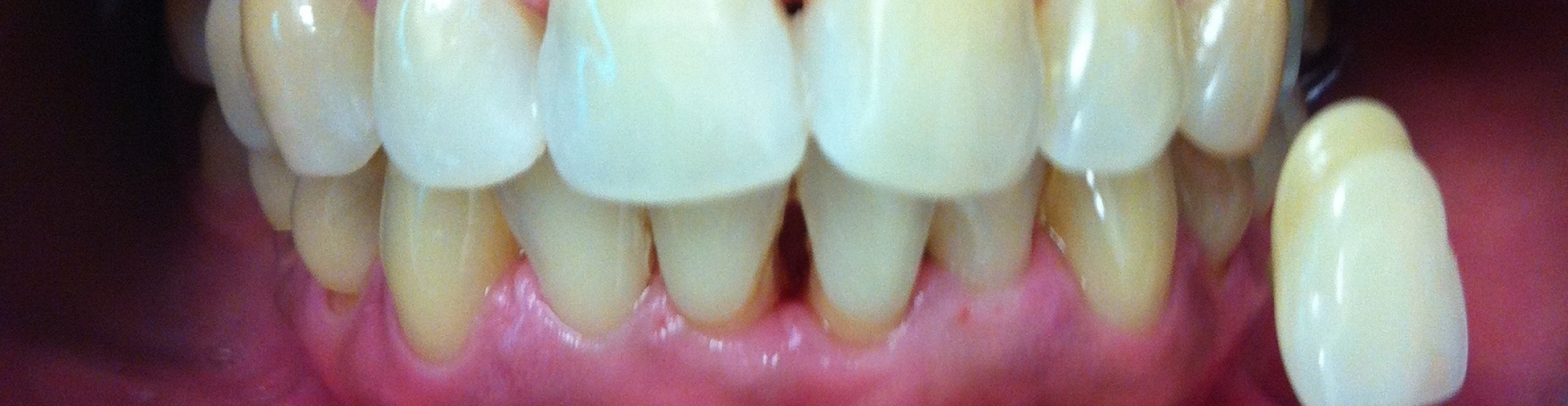 Case 1(before tx_shade D3) Jaya Dental Surgery